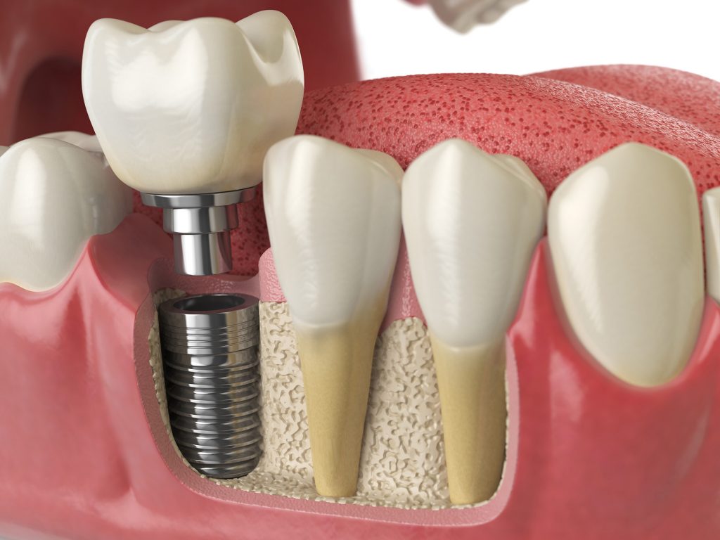 Dental implants diagram