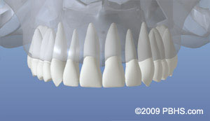 Dental implants treatment