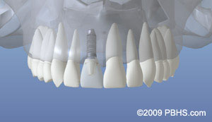 Dental Implants by BIOS