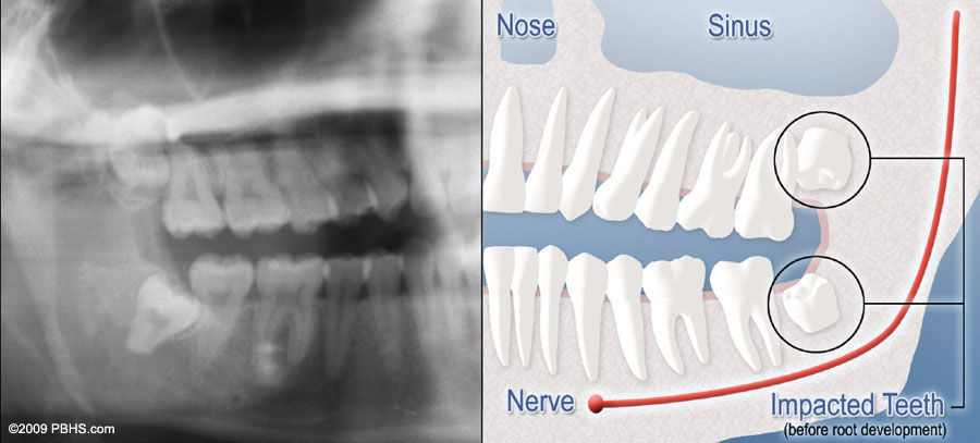 diagramof x ray and impacted wisdom teeth 1
