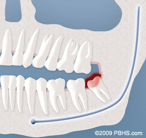 graphical presentation of wisdom tooth