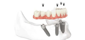 All On 4 Dental Implants