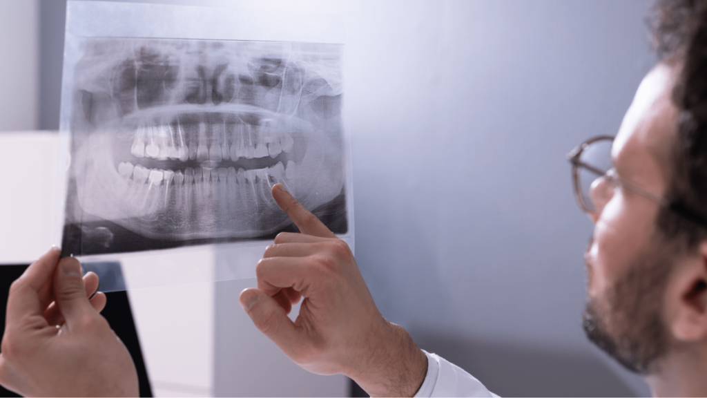 Dentist showing impacted wisdom tooth